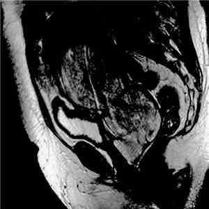 Poltergeist  - Carcinosarcoma