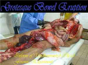 Grotesque Bowel Eruption - Inferno Of Undocumented Illegal Forensic Experim ...