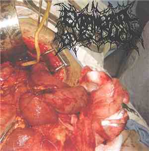 Extrahepatic Bile Duct - Extrahepatic Bile Duct