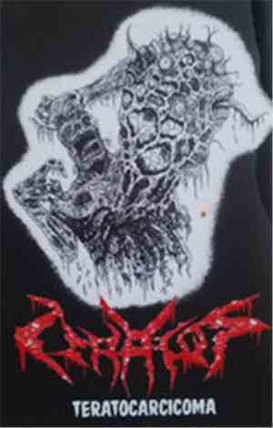 Teratos - Teratocarcicoma