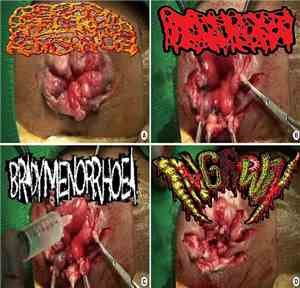 Rectal Fissure Hemorrhoids / Hydrocephalus / Bradymenorrhoea / Ingrown - Re ...