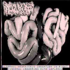 Hydrocephalus - Abnormal Mesenteric Insertion In Right Visceral Isomerism W ...